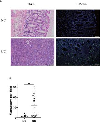 Fusobacterium nucleatum Promotes the Development of Ulcerative Colitis by Inducing the Autophagic Cell Death of Intestinal Epithelial